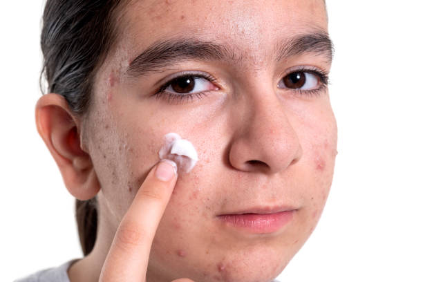 Acne-Prone Skin Care Routine: Steps for Clearer, Healthy Skin