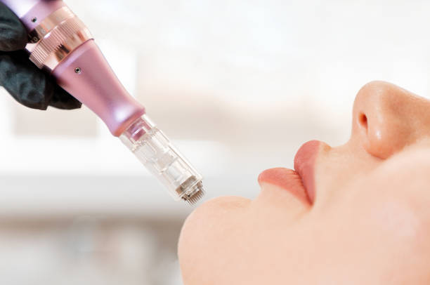 Potenza Skin Treatment: Tighten, Smooth & Rejuvenate Your Skin