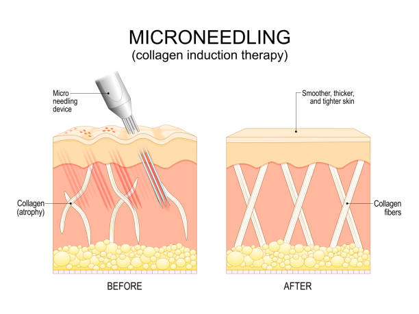 Microneedling