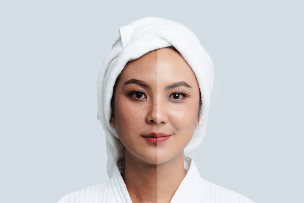 Tranexamic Acid for Hyperpigmentation: Your Guide to Clearer Skin