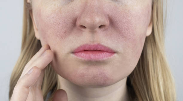 Causes and Treatments for Enlarged Pores illustration