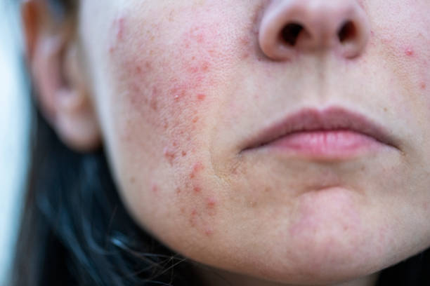 Eczema (Atopic Dermatitis): Causes, Treatments & Remedies