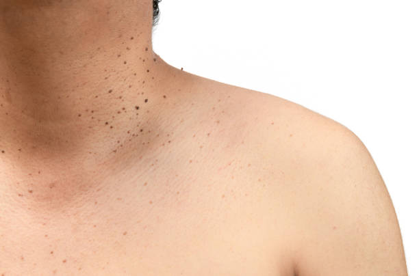 Seborrheic Keratosis : Causes, Symptoms & Removal Options