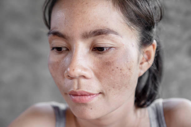 Brown Spots on Skin Treatment: Causes & Best Remedies