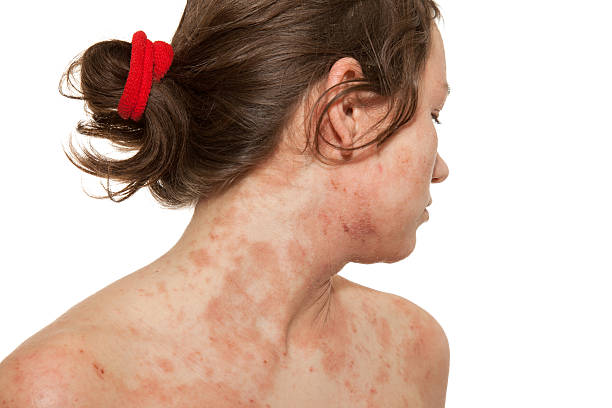 Dermatitis Explained: Causes, Symptoms & Best Skincare Tips