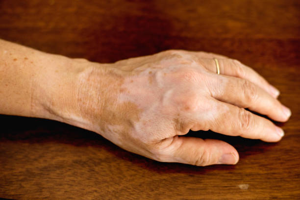 Vitiligo (Loss of Skin Color)