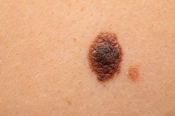 Melanoma vs Mole: Spot the Difference & When to See a Doctor