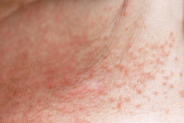 Heat Rash (Miliaria)
