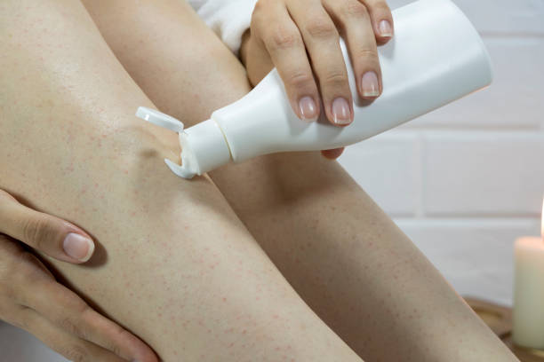 Strawberry Legs Treatment: Causes, Prevention & Solutions