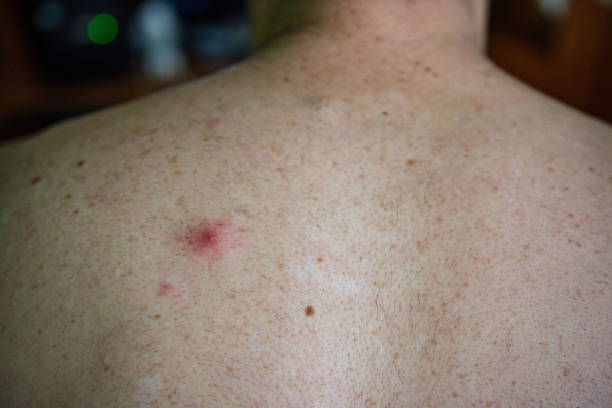 Red Bumps on Skin (Folliculitis & Infections)