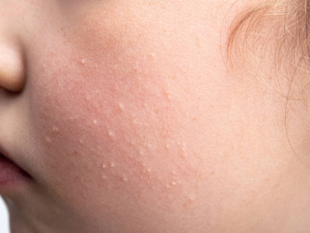 Bumps on Skin: Causes, Types & How to Treat Effectively