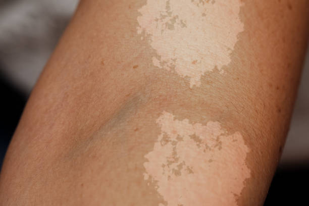 Fungal Infection (Tinea Versicolor)