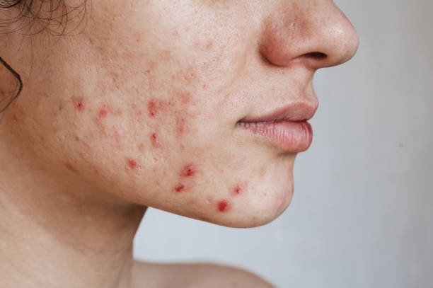 Acne Treatments: Causes & Dermatologist Tips for Clearer Skin