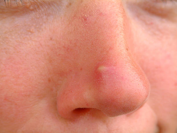 Acne vs. Other Skin Bumps