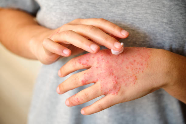 Eczema or Psoriasis