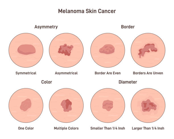 Melanoma skin cancer