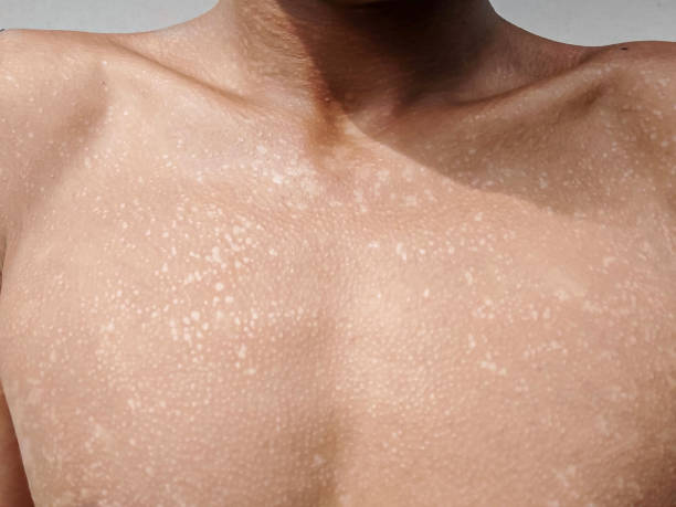 Sun Damage (Hypopigmentation)