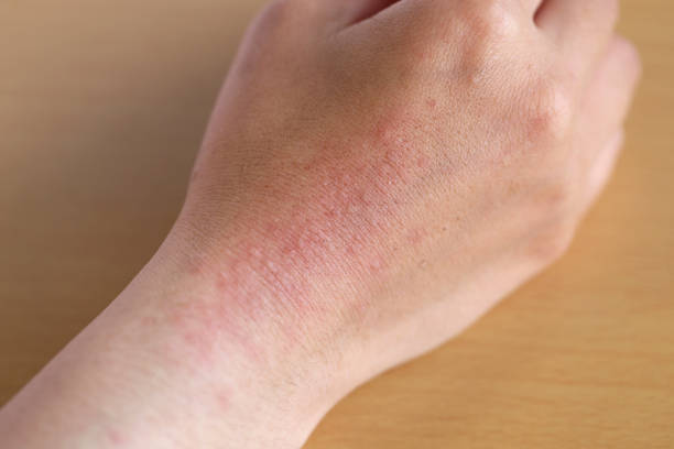 Skin Rash Bumps (Hives, Eczema, Allergies)
