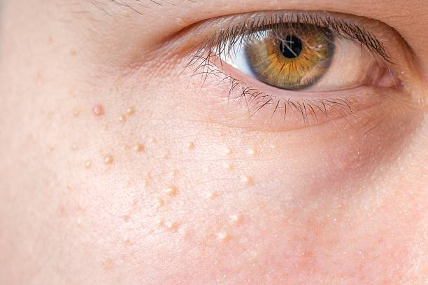 Milia (Tiny White Bumps)