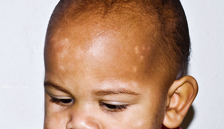 Pityriasis Alba (Mild Eczema in Kids)