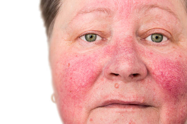 How to Manage Rosacea Naturally: Top Remedies & Tips