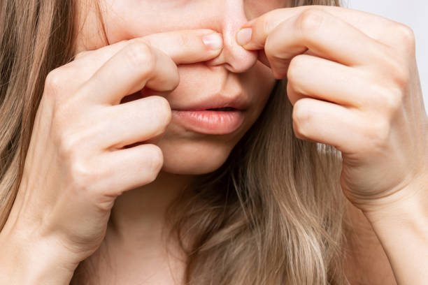How to Get Rid of Blackheads at Home