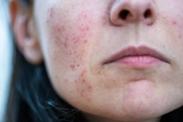 Eczema (Atopic Dermatitis): Causes, Treatments & Remedies