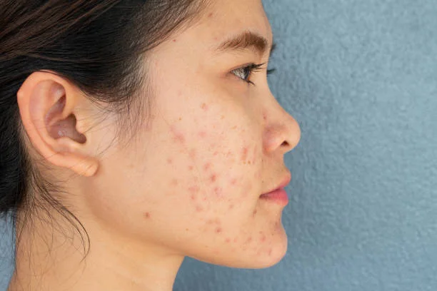Select Why Is My Acne Getting Worse? | Oily Skin During Period & Hormonal Breakouts Why Is My Acne Getting Worse? | Oily Skin During Period & Hormonal Breakouts