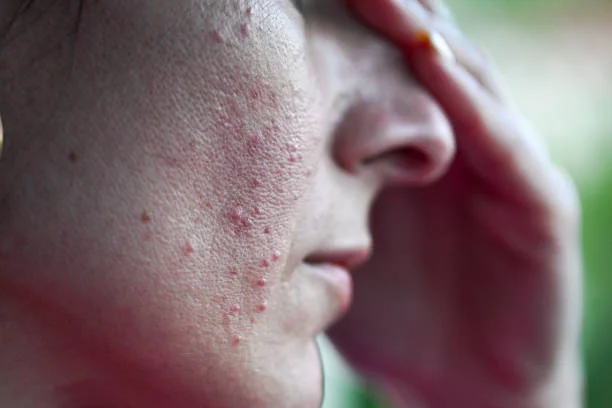 Select Why Is My Acne Getting Worse? | Oily Skin During Period & Hormonal Breakouts Why Is My Acne Getting Worse? | Oily Skin During Period & Hormonal Breakouts
