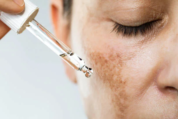 Hyperpigmentation Treatments: Types, Causes &  Treatments