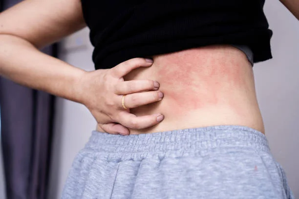 Natural Remedies for Itchy Skin: 10 Proven Ways to Stop the Itch