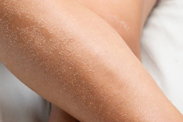 Dry Skin Causes and Treatment: What Really Works in 2025