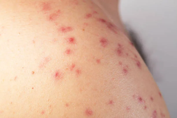 Red Spots on Skin: Causes, Symptoms, and When to Seek Help