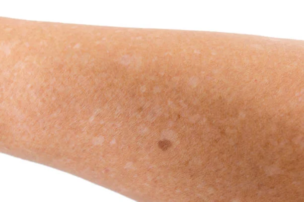 White Spots on Skin: Causes, Treatments & Remedies