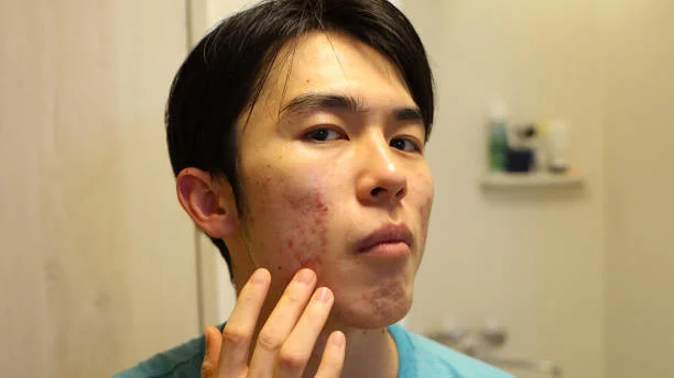 Plant-Based Skincare for Breakouts: Stress Relief for Skin